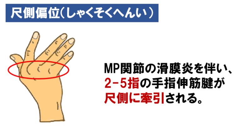 関節リウマチに対する凍結療法のリスクは何ですか?